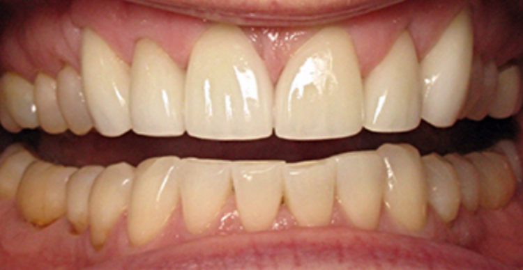 Six Front Teeth Veneers After