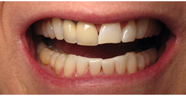 Six Front Teeth Veneers Before