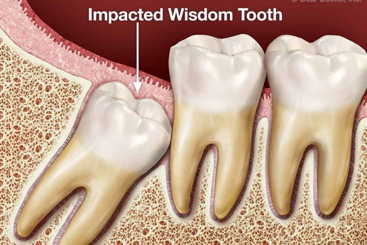 tooth extraction Newport beach ca