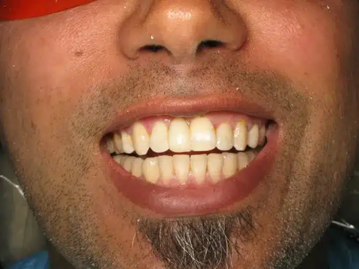veneers_after