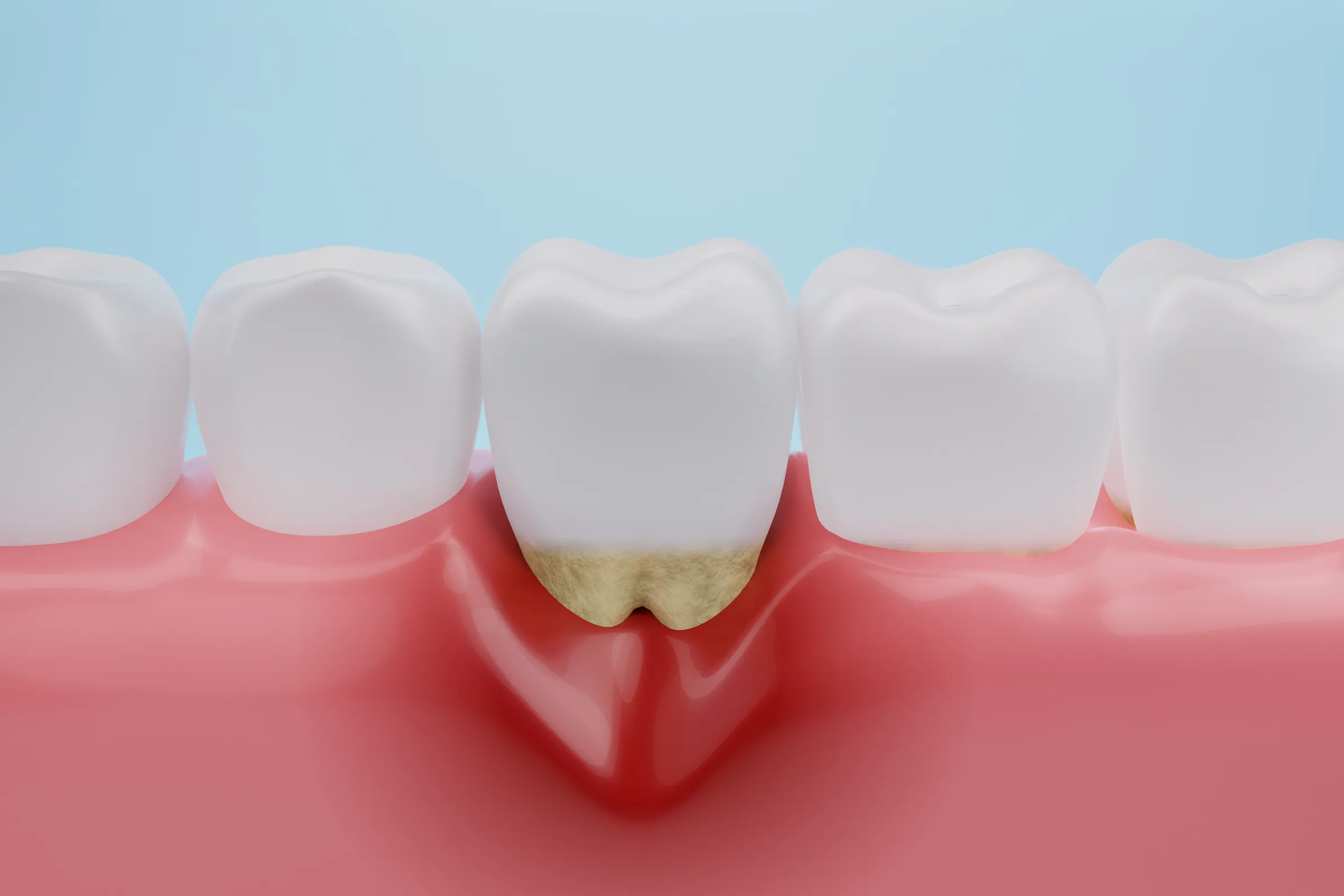 Illustration of gum inflammation and tartar around a tooth