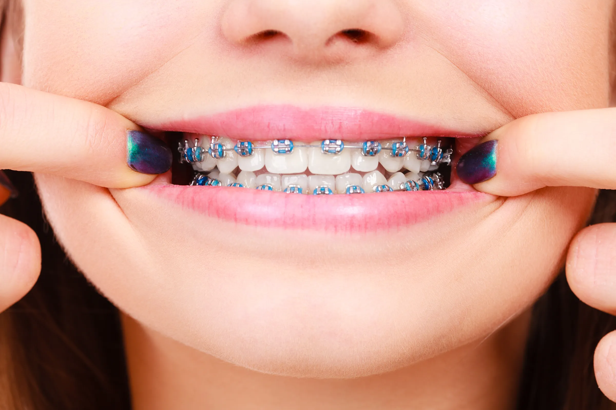 Close-up of a smile with braces as the lips are pulled back