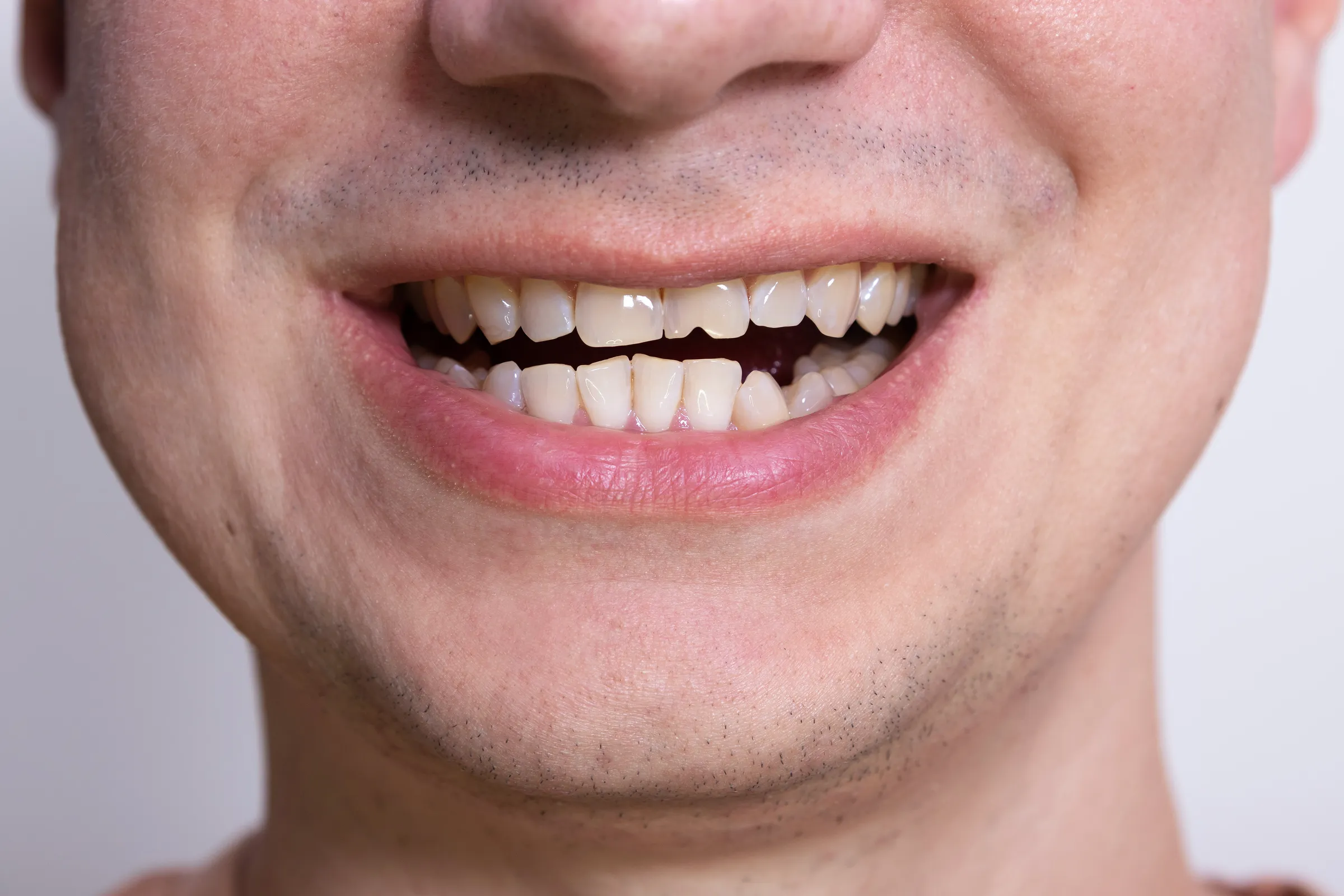 Close-up of a smile with a chipped front tooth