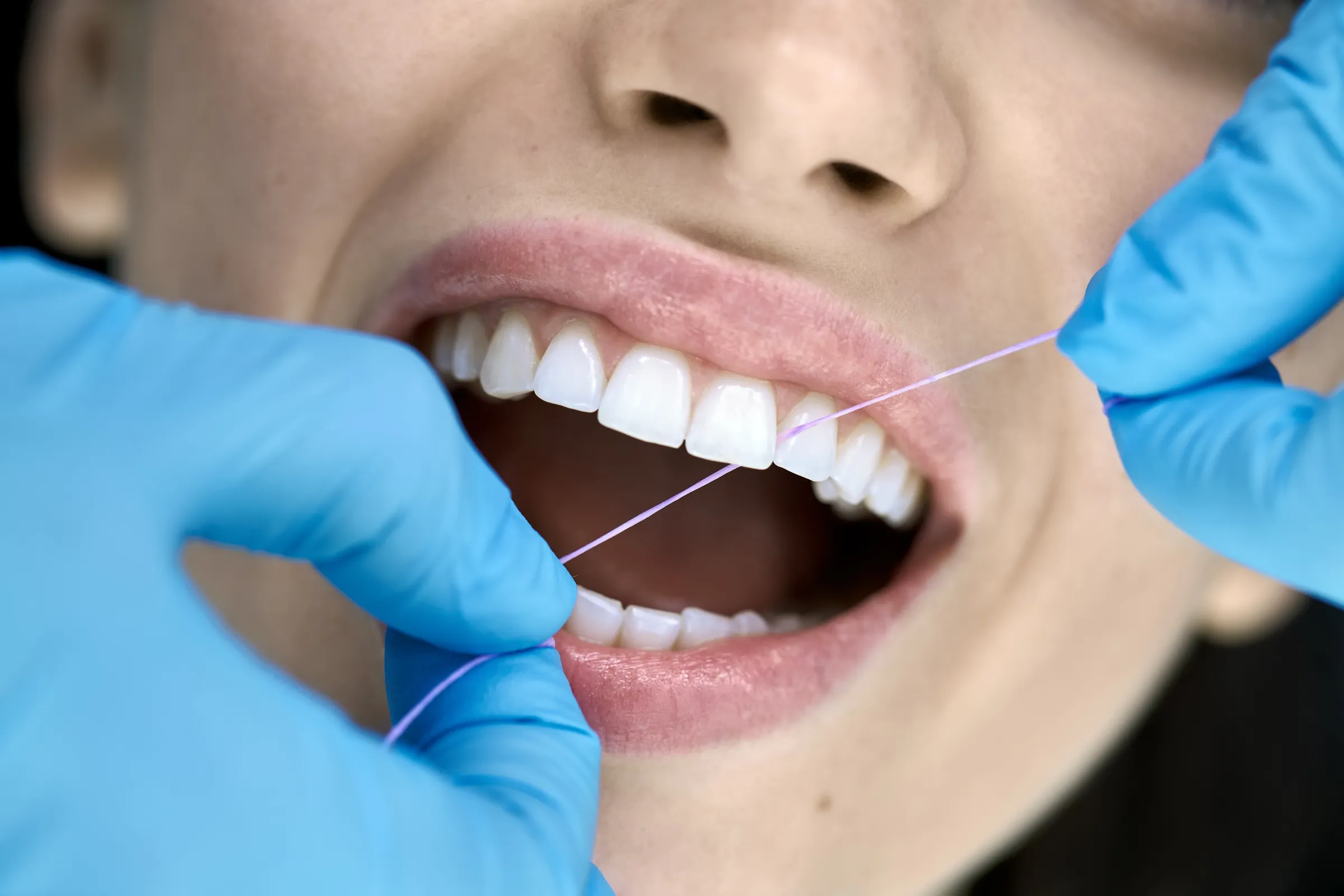 Hygienist flossing a patient's white teeth