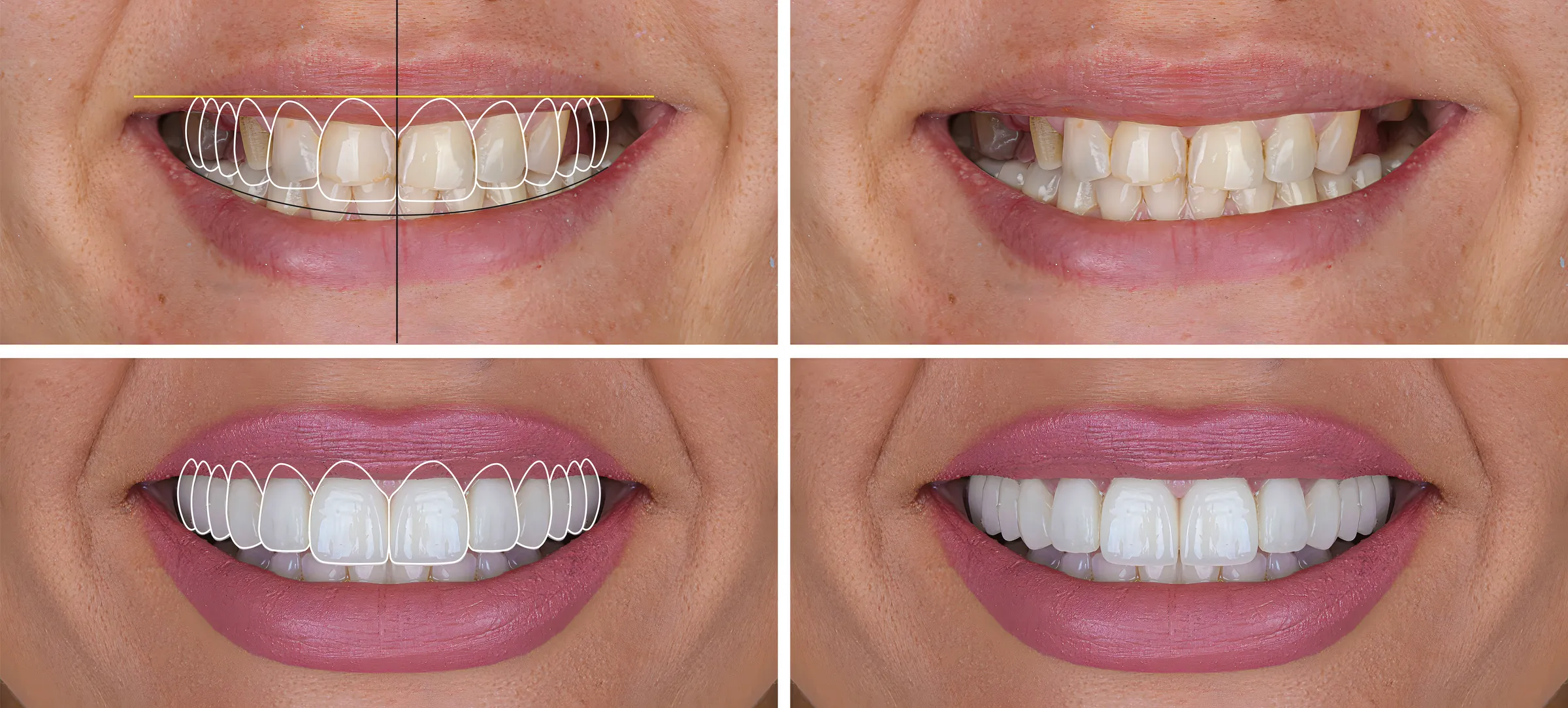 Four-panel comparison of a smile before and after a digital smile design