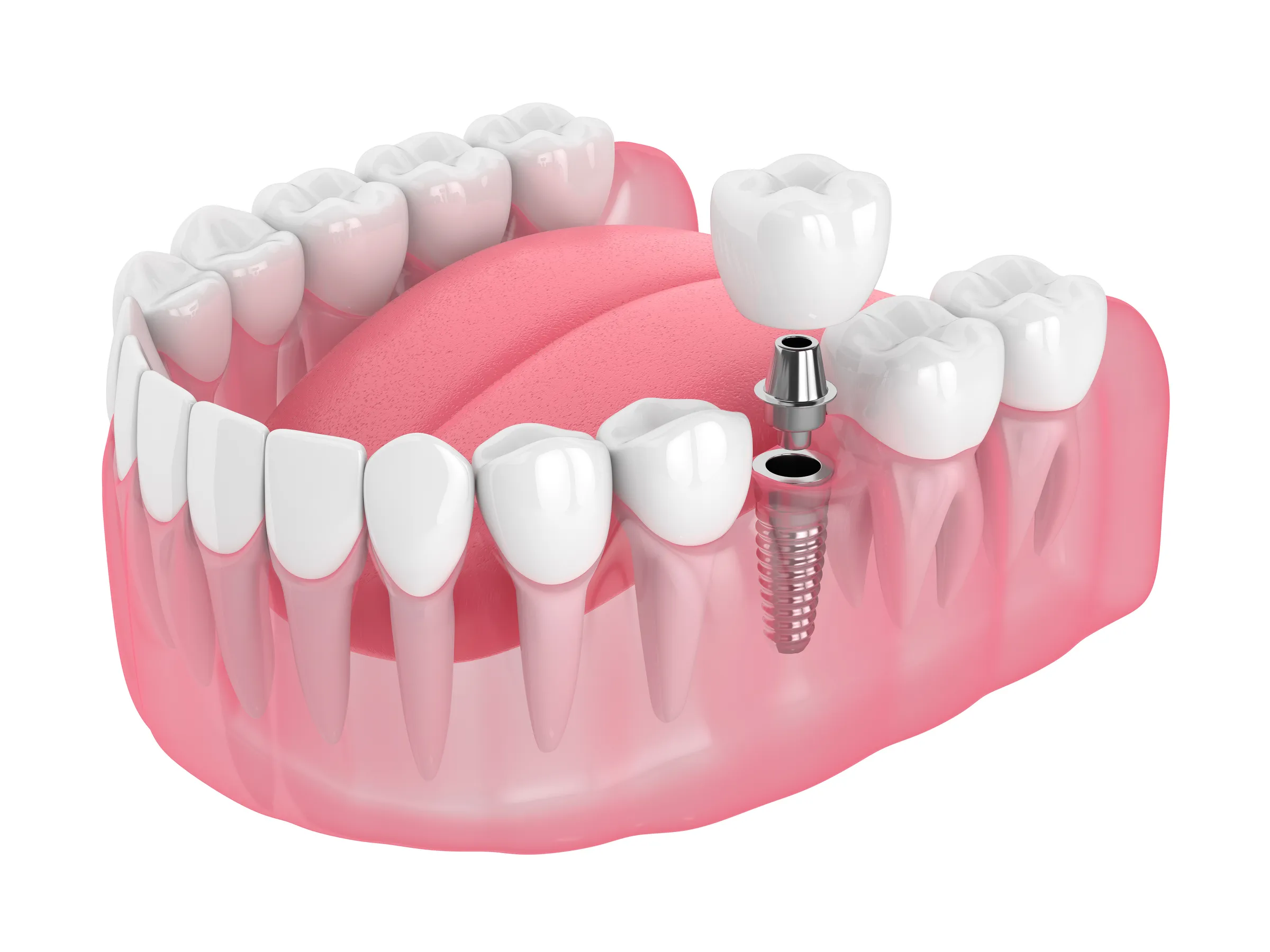 Illustration of a single dental implant in the lower jaw