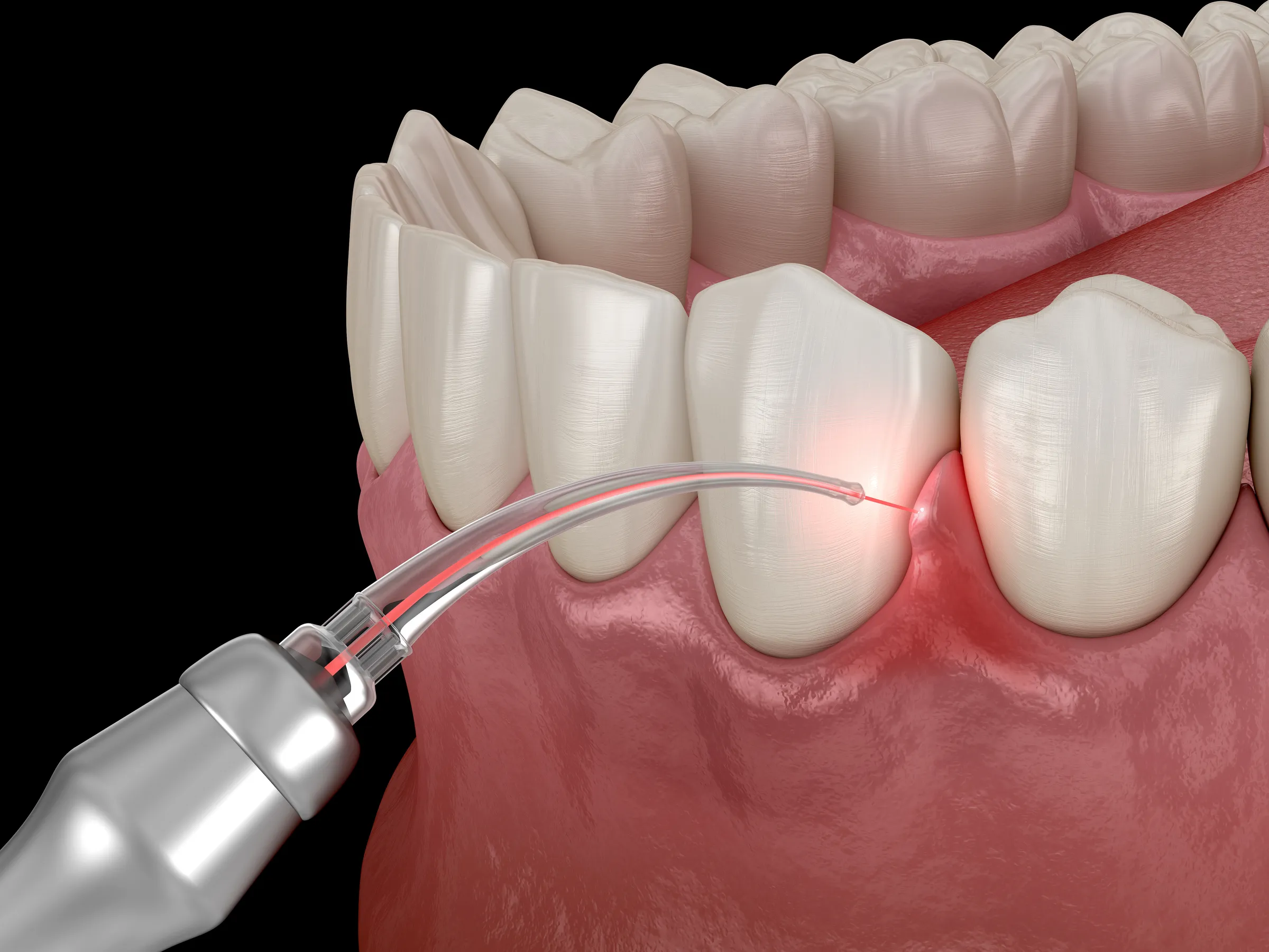 Illustration of a laser treating the gum line between teeth