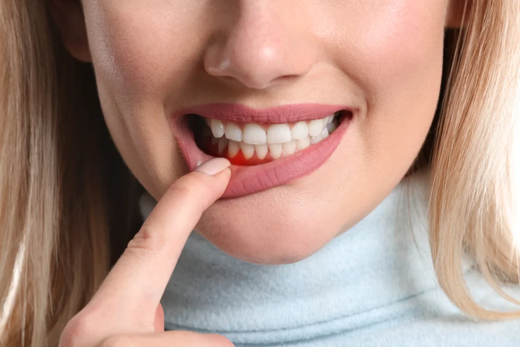 Woman pulling down her lip to show red, irritated gums