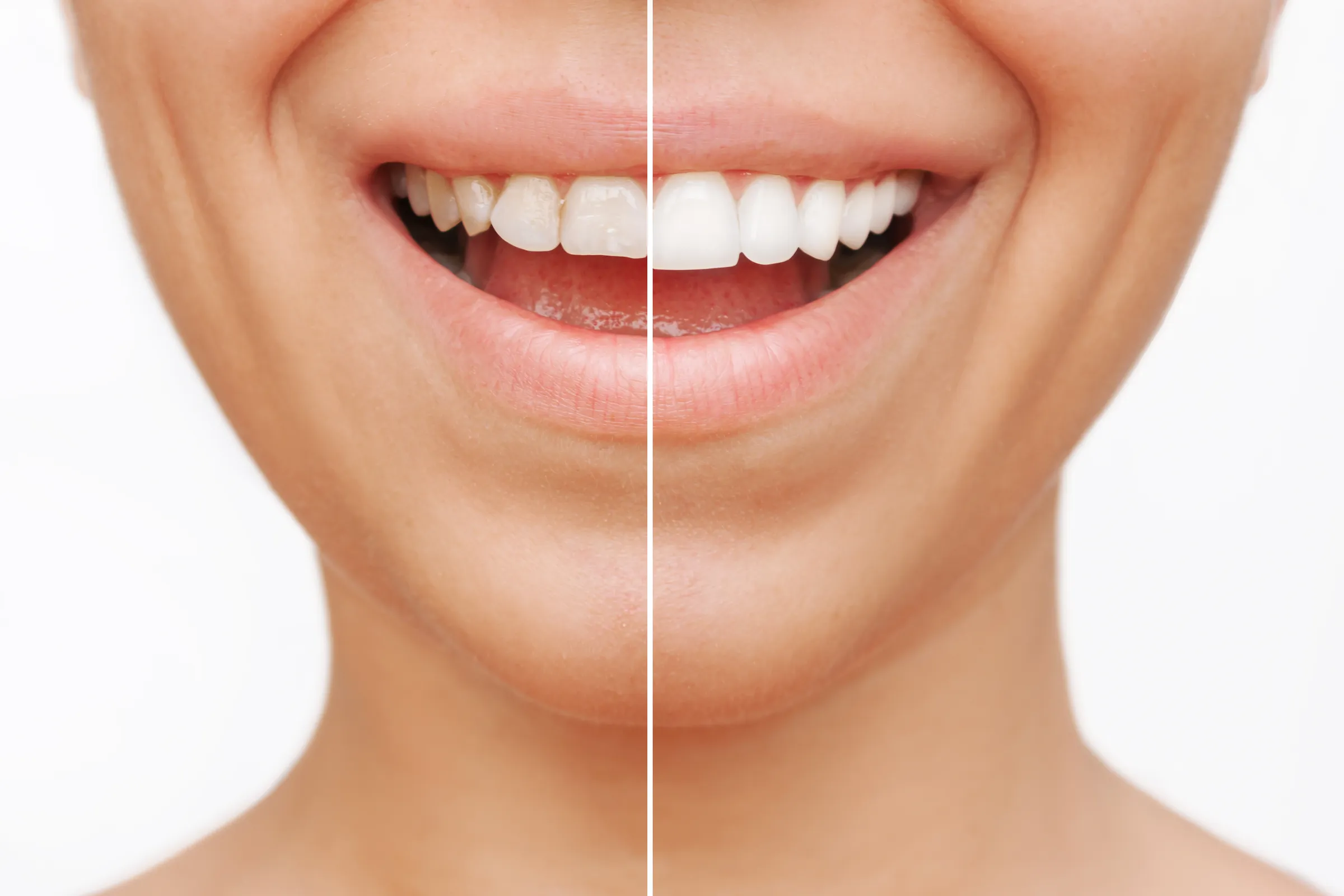 Split view of a smile before and after cosmetic treatment