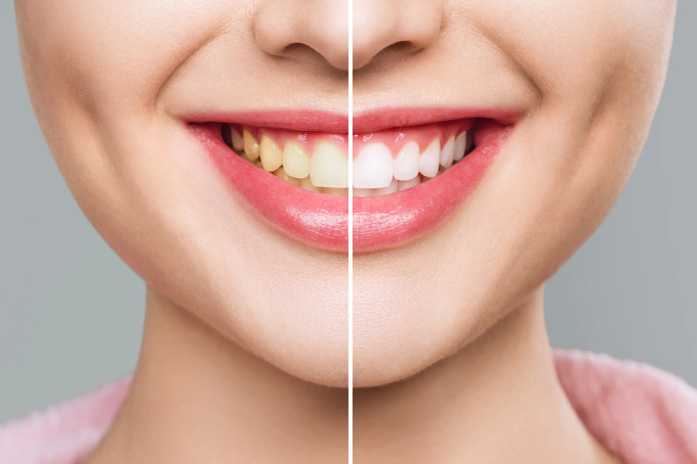 Split view of yellowed and whitened teeth in a smile