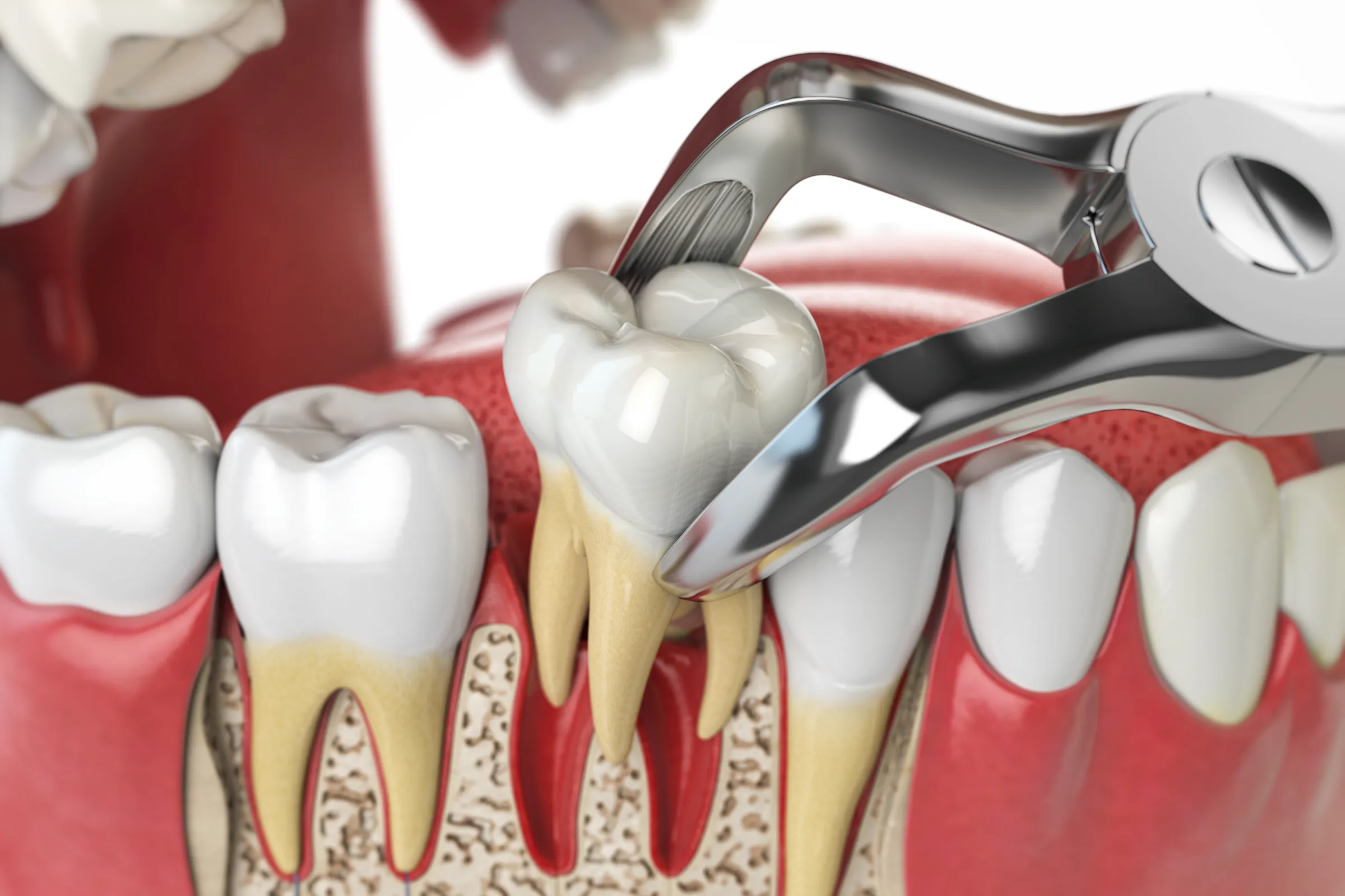 Illustration of forceps extracting a wisdom tooth