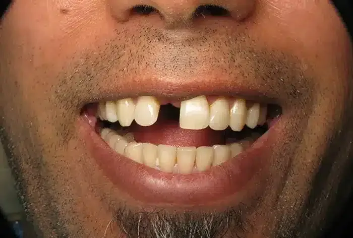 Before treatment