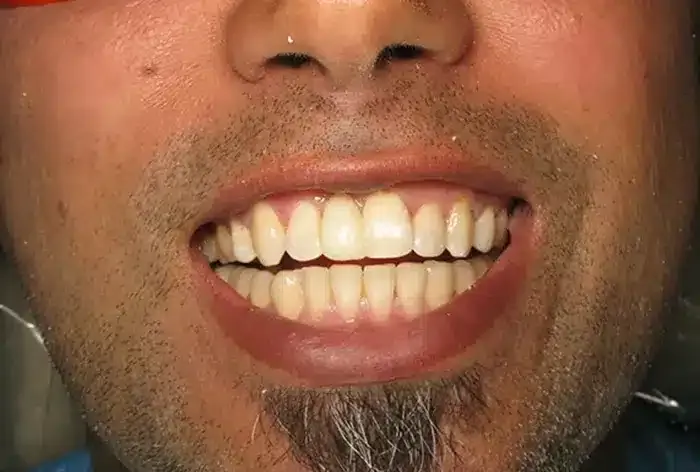 After treatment