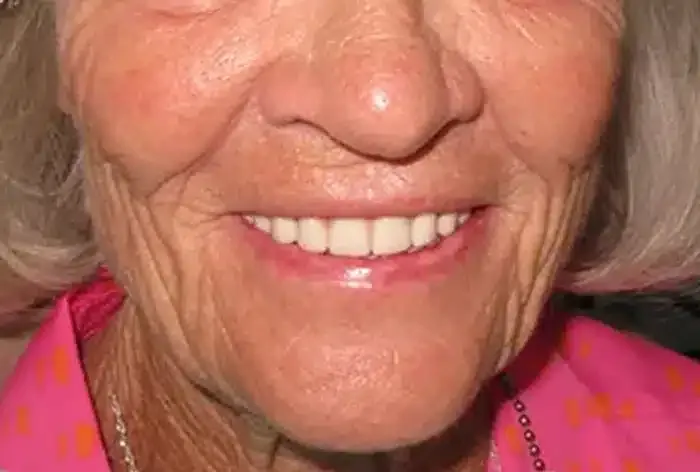 After treatment